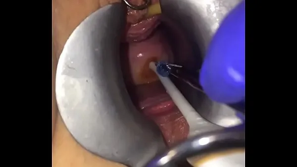 XXX Cervix extreme gyno play bästa videoklipp