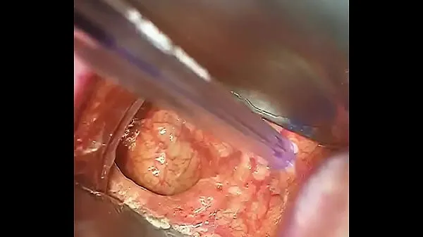 XXX Cirurgia anal top Vídeos